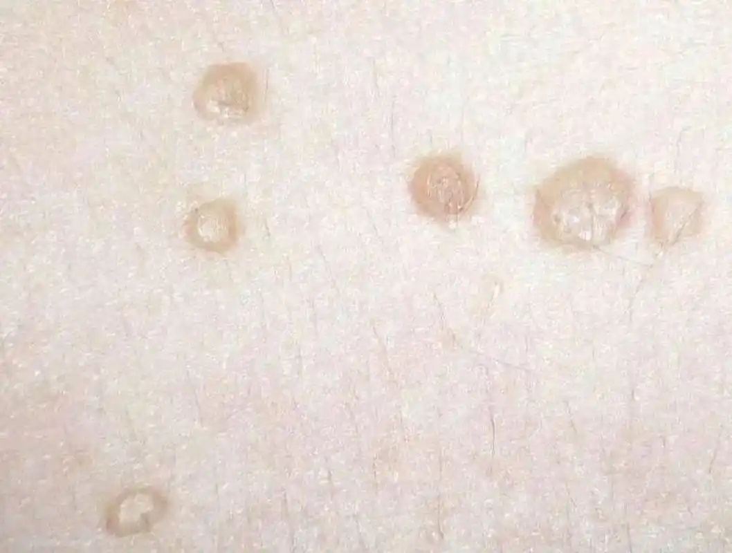 如何判断是不是得了扁平疣 扁平疣在现在生活中也算是一种比较常见的