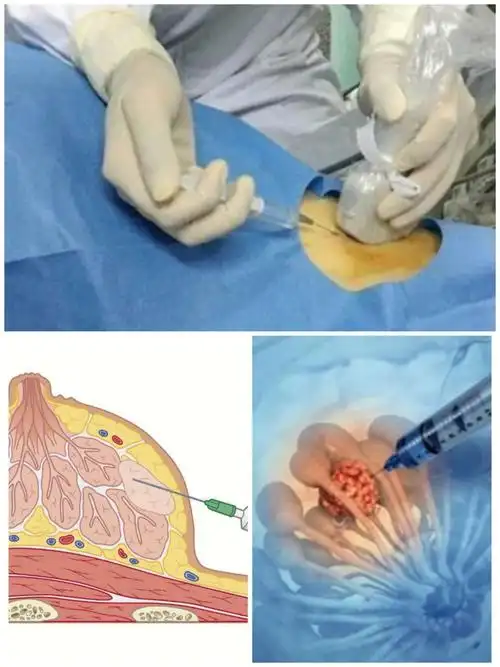彩超引导下脓肿穿刺和微小结节术前定位
