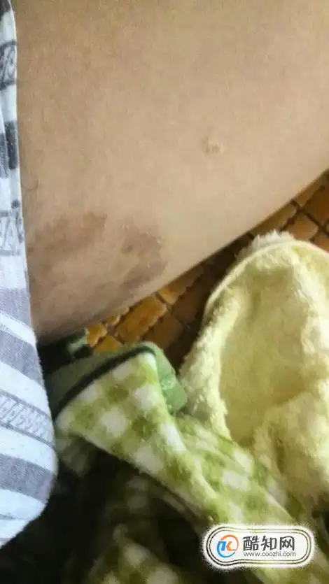 大腿内侧股癣怎么治涂了很多药膏皮肤很黑优质