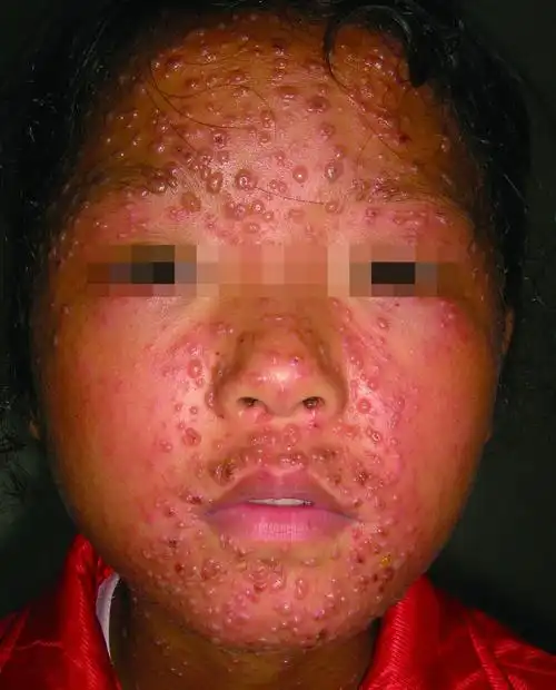 皮肤性病科图谱: 病毒性皮肤病 水痘