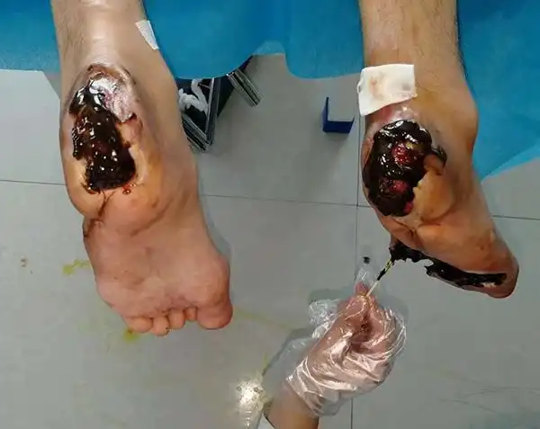 河北糖尿病足患者输血三月仍要截肢是什么方法让他保住双脚