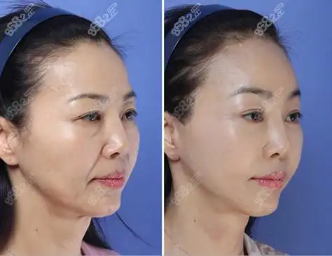 韩国梦想整形外科医院额头和面部提升对比图