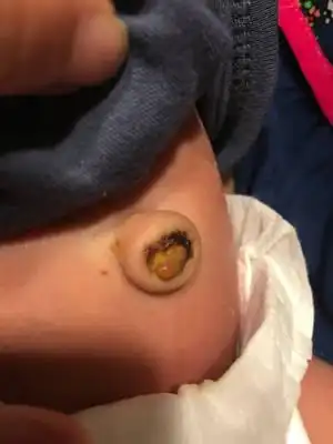 之后肉芽会脱落吗?查了资料有说是脐茸 什麼 有懂的妈妈吗