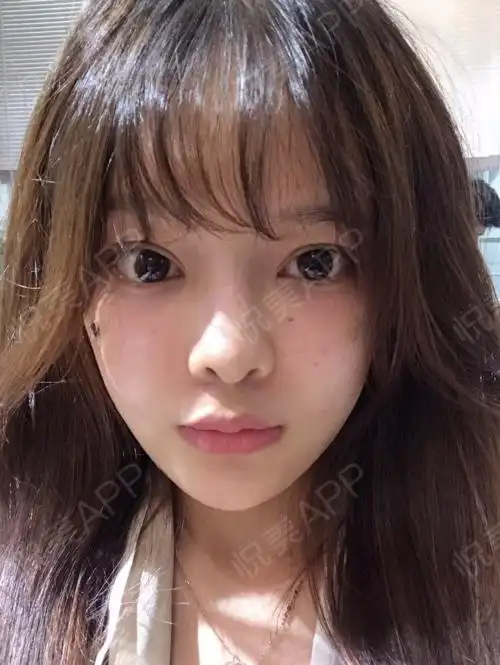 天_面部填充术后4天_丰苹果肌术后4天_自体脂肪术后4天_面部轮廓术后4