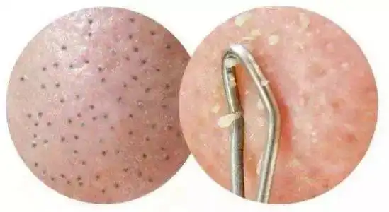 黑头挤出来是什么样子