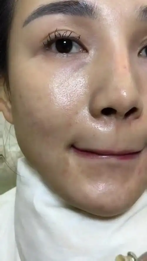 暗黄大油皮怎么办?