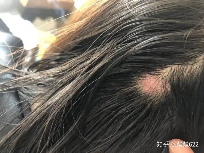 为什么抠下来大块的头皮屑会有瞬间的快感