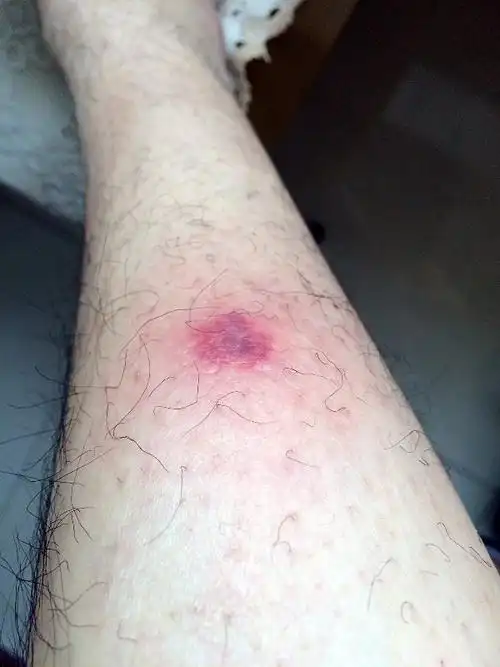 四肢局部突然之间泛起红肿 不痒但是肿痛 类似于疖子似