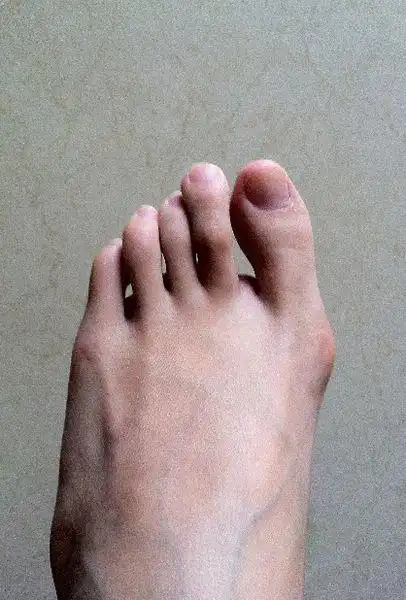 我的趾外翻严重吗?(有图片)24岁,女 .