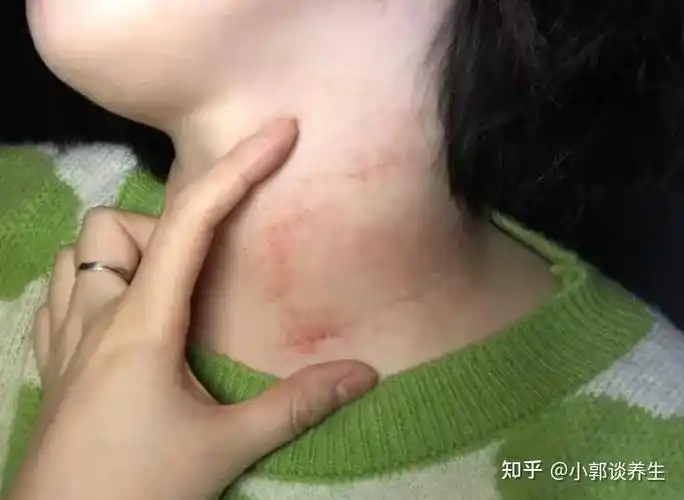 若是真的查出hpv也不要慌张,只要不是到了宫颈癌晚期,治愈率还是很高