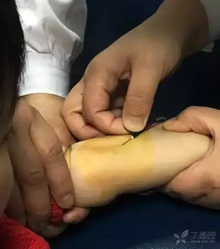 是指在欲穿刺的静脉上,针头与皮肤成 10～45 度角,针头斜面向上,右手