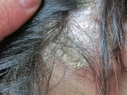 女生的头癣初期图片_有来医生