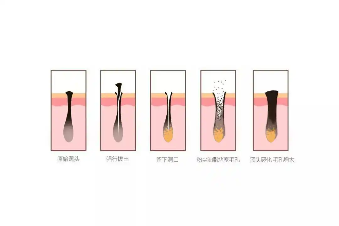 花几千块都去不掉黑头,原因在这