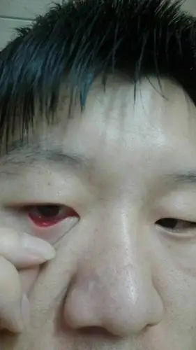 这几天眼睛里长了个白色的小疙瘩,眼睛出现肿痛了,这是什么病?