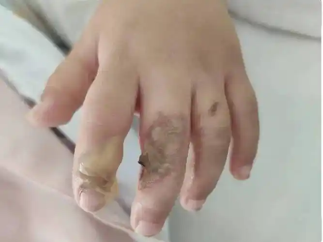 宝宝家中被电击手部烫伤医生换药好心疼