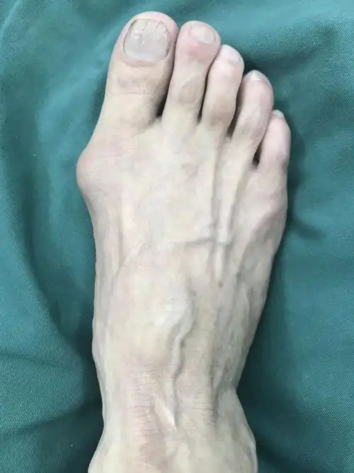 俗称"大脚骨",现行右足矫形,软组织,籽骨松解复位 chevron截骨 关节囊