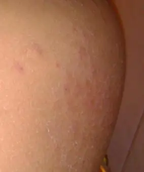 屁股上长了小包包,晚上就很痒.