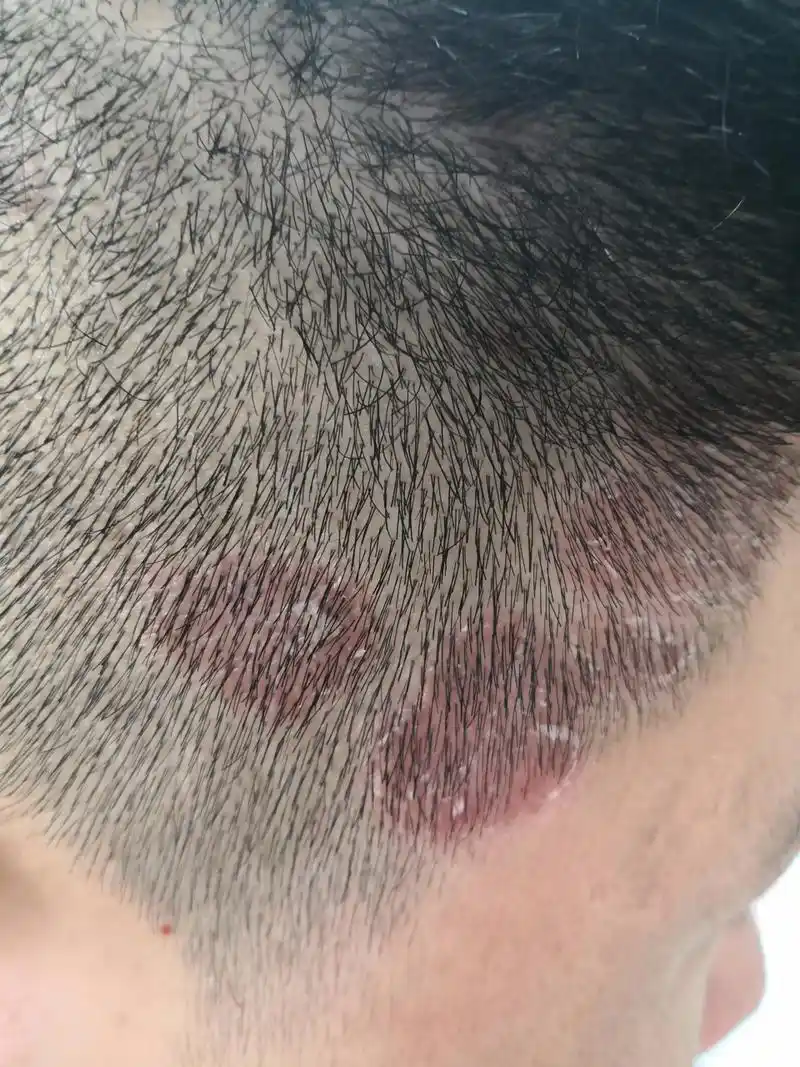 头皮鳞屑性斑块症状.四肢散发点状红斑.