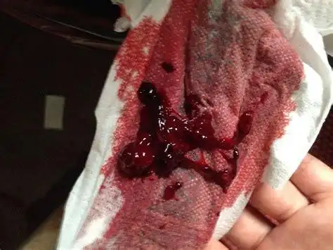 月经突然量大有血块月经突然量大有血块是怎么回事2022已更新今日资讯