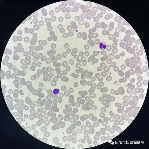 一例血常规中发现的红细胞冷凝集