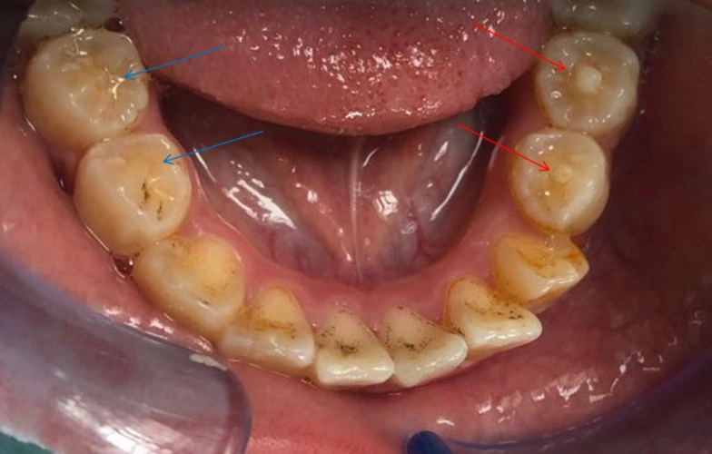 孩子新换的后牙中间多了一个尖_腾讯新闻