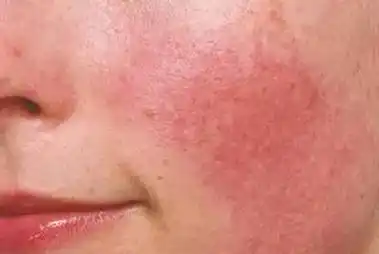 敏感肌是什么症状_百科-8s新商盟