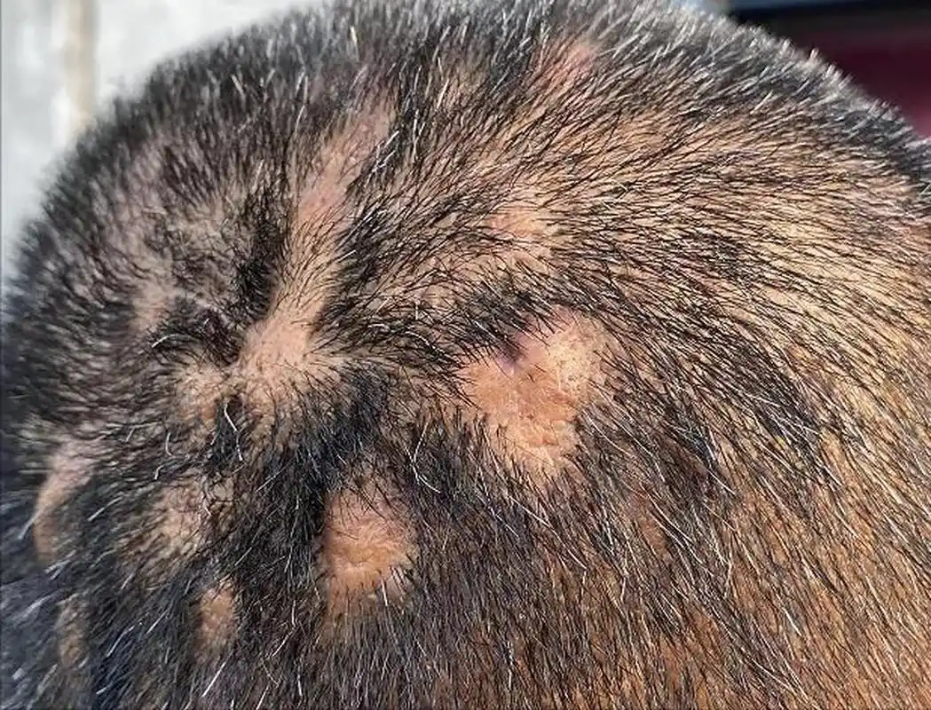 2,项部疤痕疙瘩性毛囊炎:在后发际线出现结节和硬块,青年男性易患且