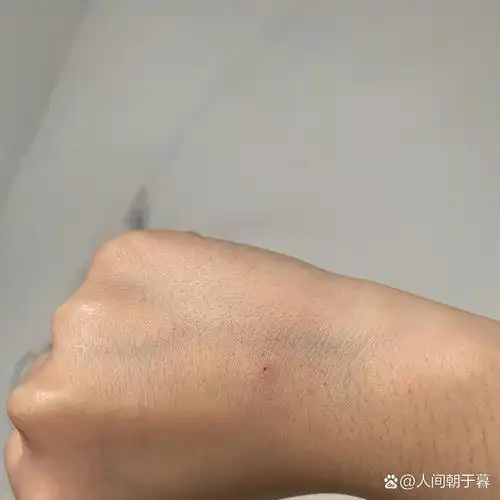 早上起来 右手手背突然多了个痣是怎么了 我扣了半天都抠不下来