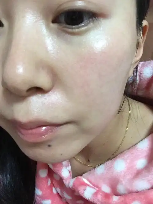 角质层受损篇(一)