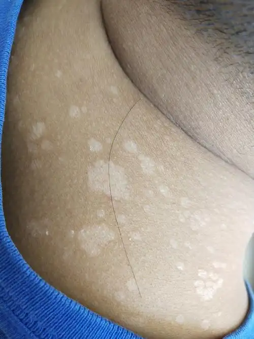 花斑癣学名花斑糠疹,是一种真菌感染引起的浅表性皮肤病.