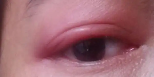 小编为您找了一些快速消除眼睛浮肿的方法,一起来看看