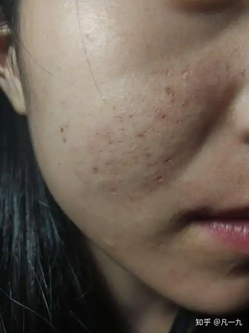 这种程度的痘坑可以自己修复吗