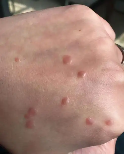 手上长扁平疣怎么办?医生提醒:不要用手去抠「它」