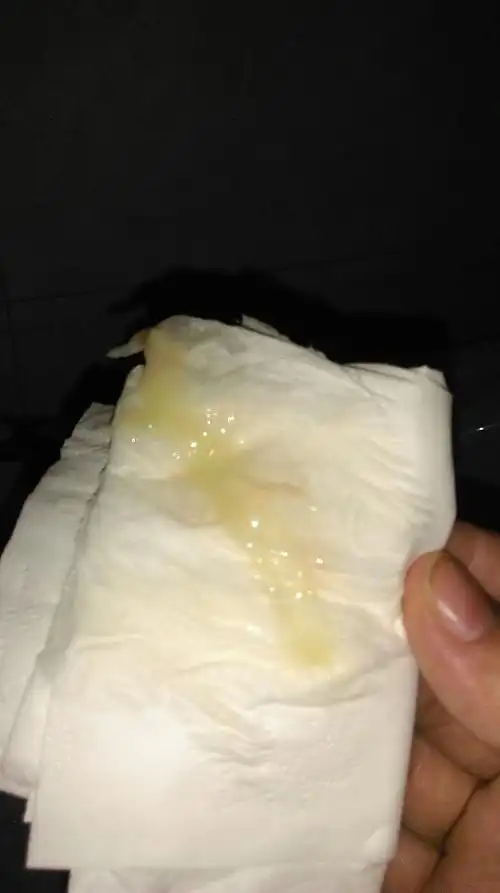 孕晚期白带有血丝是快生了吗排卵期白带带粉色血丝是怎麼回事?