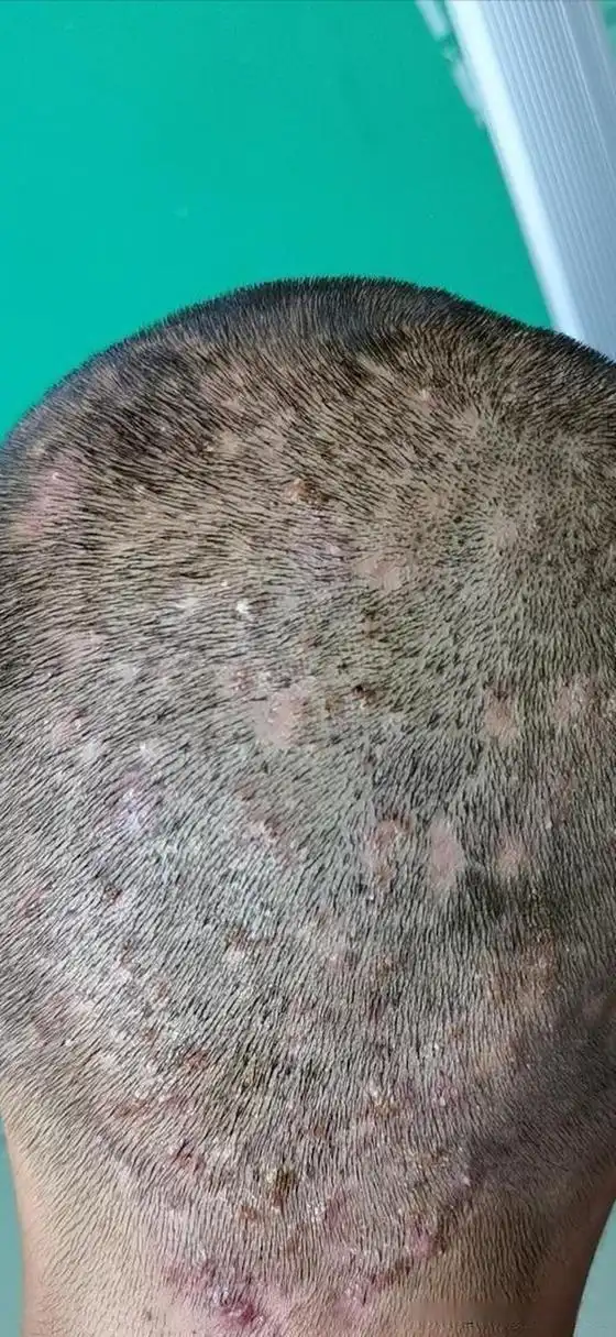 别让毛囊炎拖累孩子的未来!