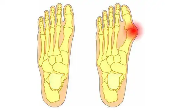 痛风/拇外翻大脚趾疼常表现为前脚掌疼痛,同时前脚掌中间位置会出现很