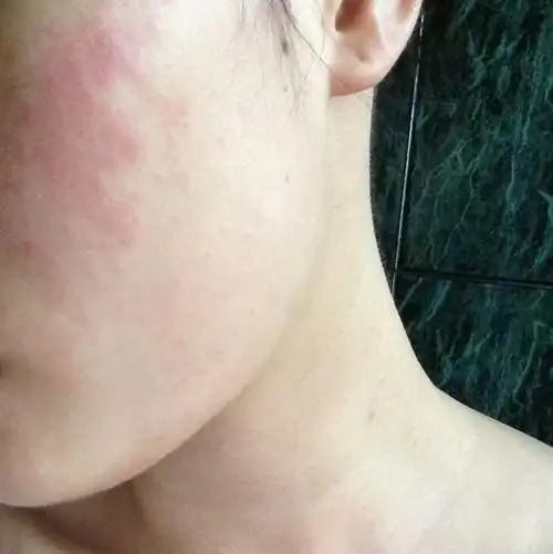 我皮肤又痒又红肿,涂了点花露水还很痛,是过敏吗?