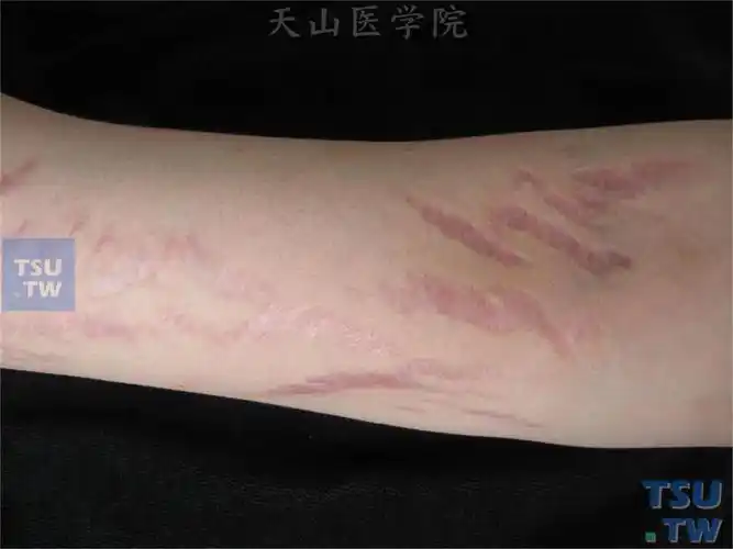 萎缩纹(striae atrophicae)症状表现 - 皮肤病学 - 天山医学院