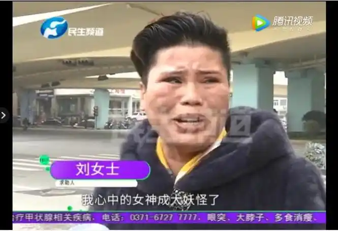 整容失败案例女子整容失败崩溃大哭