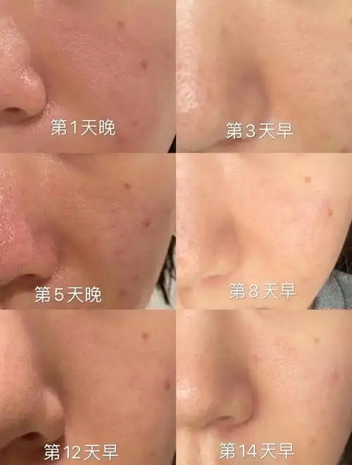 毛孔粗大学生党按面积医美啥项目比较推荐毛孔大到哭聊