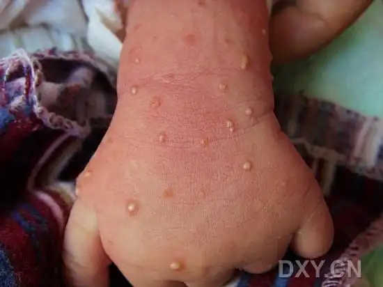 【病例讨论】小儿15天,皮肤脓疱2天 [病例帖]