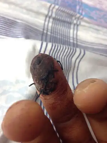 现在手指发黑是坏死了吗?饱满度好的.手指冰凉的…摸起来没