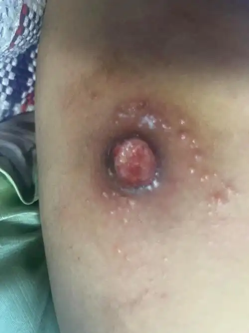 有效经验|时隔两个月的火疖子好的差不多了