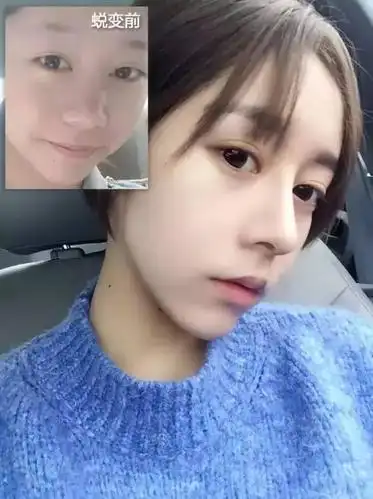 垫高鼻梁就能让颜值飙升nonono
