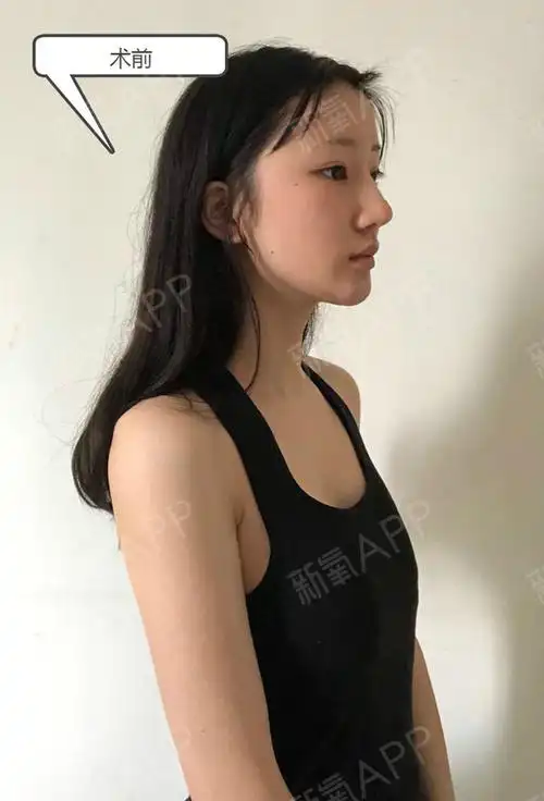 03小胸必看假体隆胸知识扫盲05