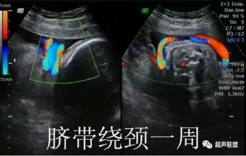 青海省康乐医院超声科提醒您警惕脐带绕颈对胎儿的不良影响