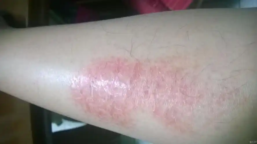 小腿局部皮肤红痒蜕皮请问是什么疾病如何治疗呢