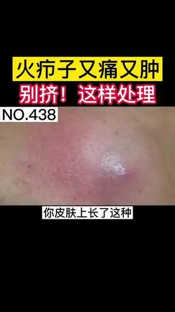 火疖子 不要乱扣乱挤,小心感染留疤.