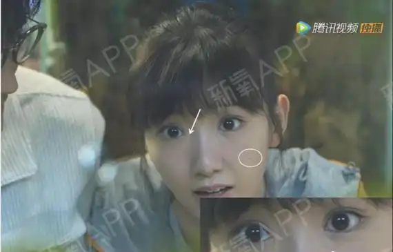 毛晓彤眼角这是疤痕还是内眦赘皮