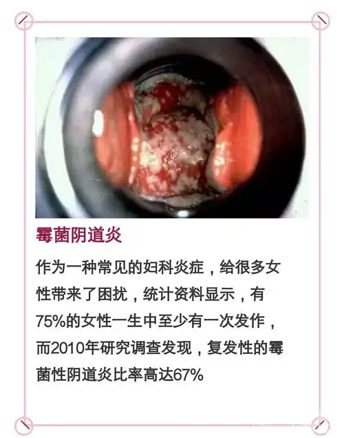 霉菌性阴道炎反复发作,你真正做到夫妻同治了吗?